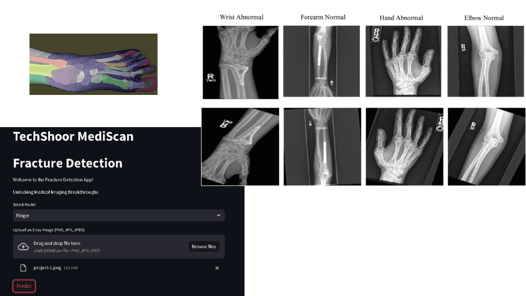 Fracture Detection (MURA)